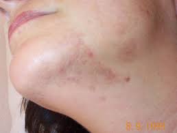 Diffuse pigmentation